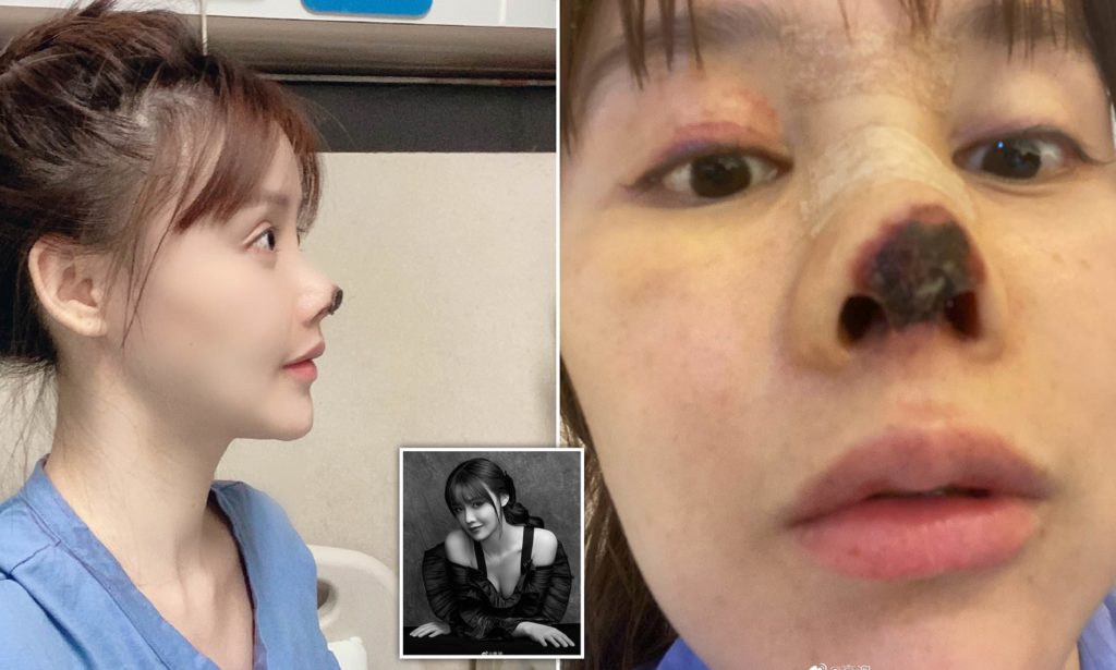 Woman Shows Botched Plastic Surgery Which Turned Her Nose Black With ...